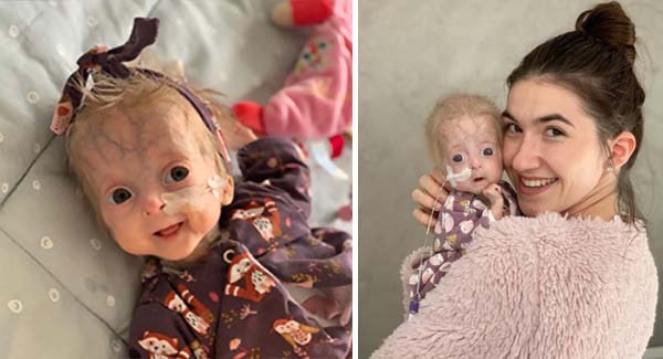 The Baby With Neonatal Progeria Fought With A Smile – The Sad Story of Eline Léonie!