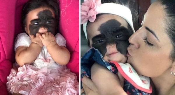 Baby With Batman Mask Birthmark Becomes Social Media Superstar As She Gets Miracle Treatment!